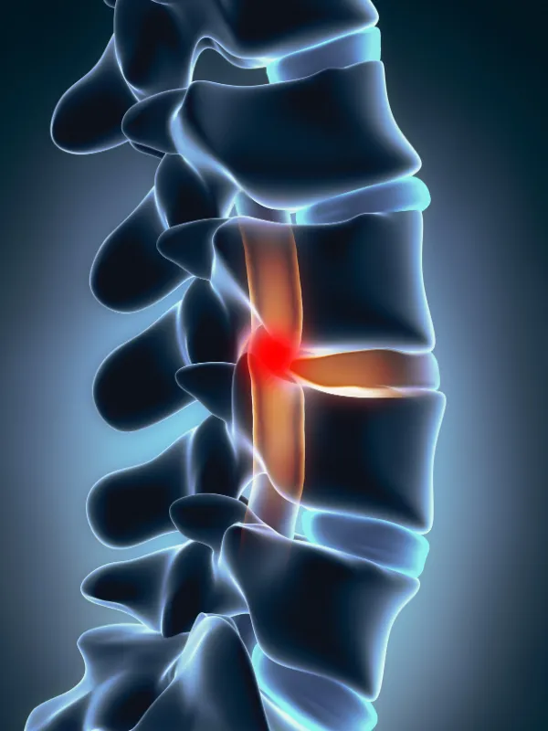 Cirugía de Tumor en Médula Cirugía de Tumor en Médula culiacan