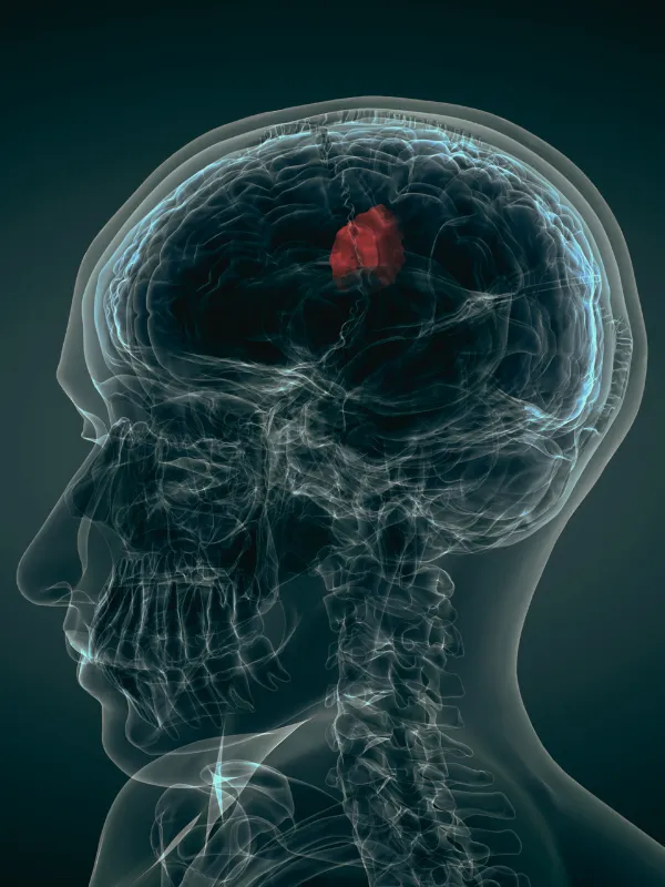 Cirugía de tumor cerebral Cirugía de tumor cerebral