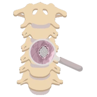 Tumor en la Médula Espinal Clínica de Neurocirugía