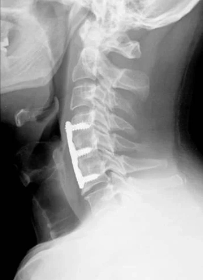 artrodesis cervical Artrodesis Cervical Anterior en Culiacán