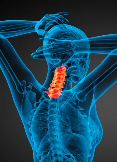 cervical anterior Artrodesis Cervical Anterior en Culiacán