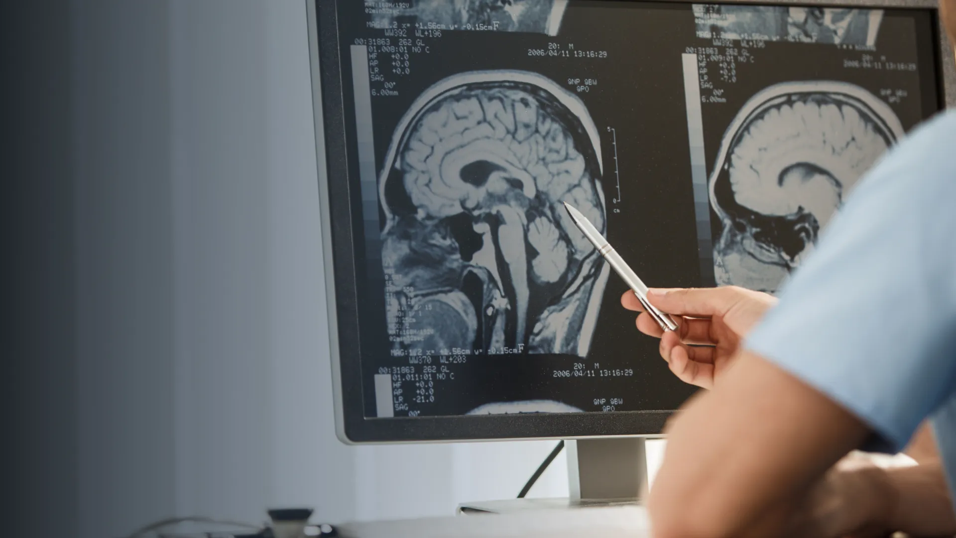 servicios de neurocirugia Microcirugía de la Hipófisis y Región Selar en Culiacán