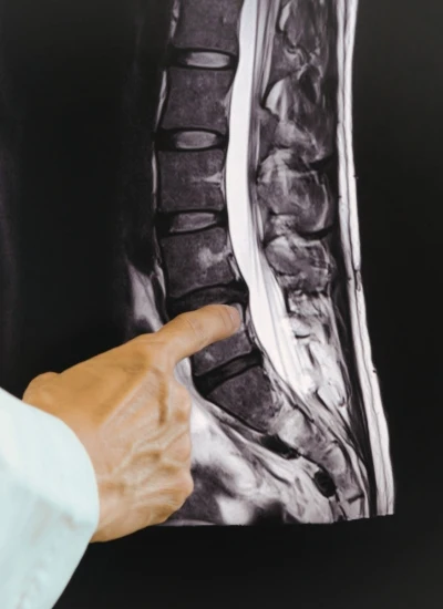 tumor en medula espinal Cirugía de Tumor en Médula Espinal en Culiacán